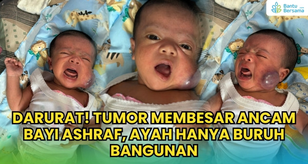 Darurat! Tumor Membesar Ancam Bayi Ashraf, Ayah Hanya Buruh Bangunan