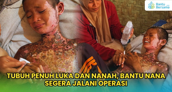 Tubuh Penuh Luka Dan Nanah, Bantu Nana Segera Jalani Operasi