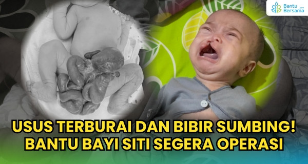 Usus Terburai Dan Bibir Sumbing! Bantu Bayi Siti Segera Operasi