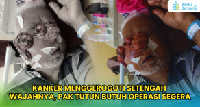 Kanker Menggerogoti Setengah Wajahnya, Pak Tutun Butuh Operasi Segera