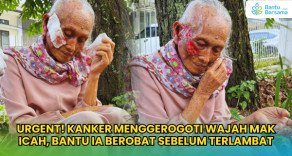 Urgent! Kanker Menggerogoti Wajah Mak Icah, Bantu Ia Berobat
